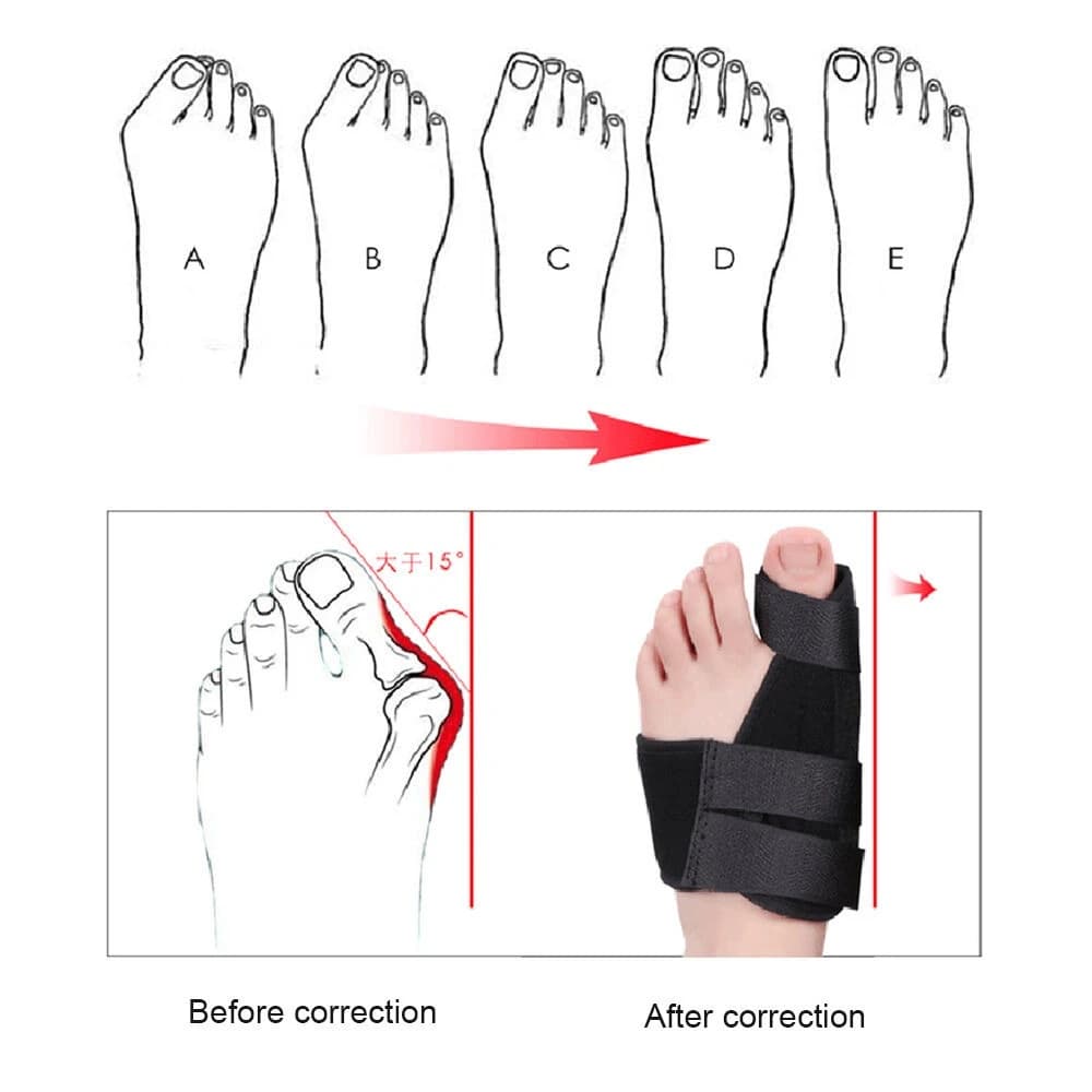 Soft Bunion Corrector Toe Separator Splint Correction System Medical Device Hallux Valgus Foot Care Pedicure Orthotics- 1 pcs